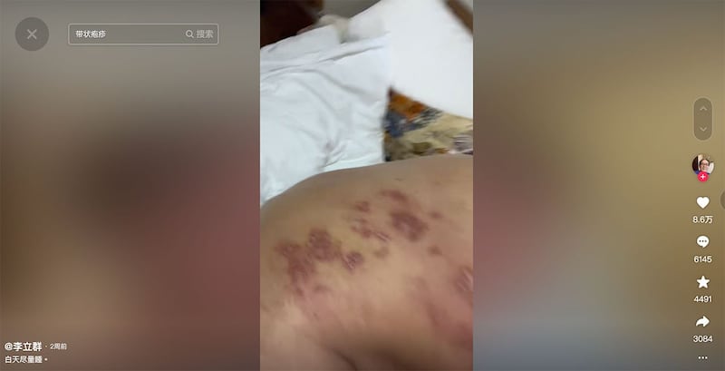 李立群在视频前低头秀主背后的疱疹。(李立群抖音/夏小华提供)