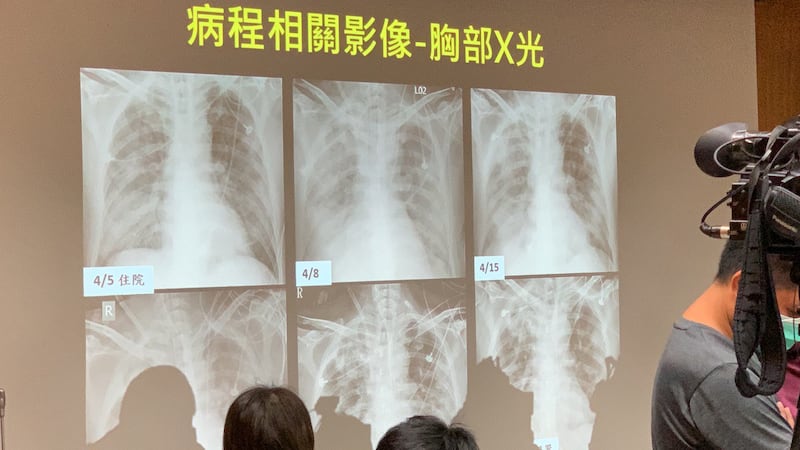 A先生肺部X光医治过程变化。(记者夏小华翻摄)